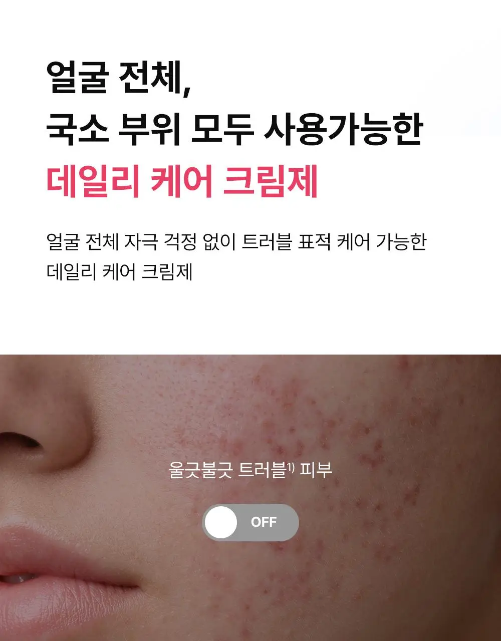 (하루특가)[단독기획] 동아제약 아크네 프로 크림제 30ml 기획(+3ml+겔제3ml) 상세페이지 10